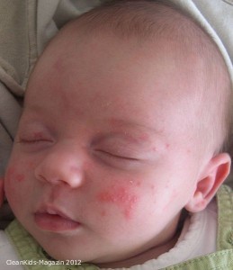 Baby-Akne: Regelmäßige sanfte Gesichtsreinigung mit warmem Wasser reicht aus