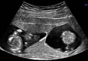 Zwillinge im Ultraschall: am keilförmigen Ausläufer der Fruchthülle, dem so genannten Lambda-Zeichen, können Ärzte eine „dichoriotische“ Zwillingsschwangerschaft sicher erkennen. Jedes Baby hat seine eigene Plazenta. - Bildquelle: PD Dr. K.-S. Heling