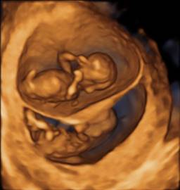 Auch im 3D-Ultraschall können Pränatalmediziner „dichoriotische“ Zwillinge in der Frühschwangerschaft gut erkennen. Hier in der 13ten Schwangerschaftswoche.  Bildquelle: PD Dr. K.-S. Heling
